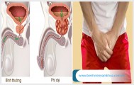 Bệnh phì đại tuyến tiền liệt là gì? Cách phòng tránh ra sao?