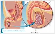 Bệnh ung thư tinh hoàn nguyên nhân và triệu chứng bệnh