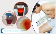 Xuất hiện máu trong nước tiểu và cách trị hiệu quả