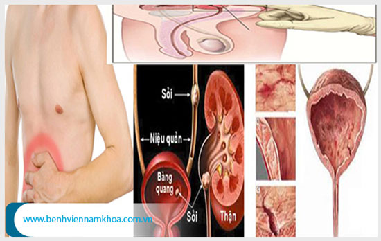 Đau bụng dưới ở nam giới là dấu hiệu của nhiều bệnh nguy hiểm
