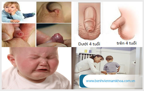 Hình ảnh triệu chứng viêm bao quy đầu ở bé trai